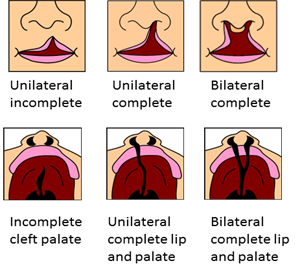 Cleft Lip & Plate